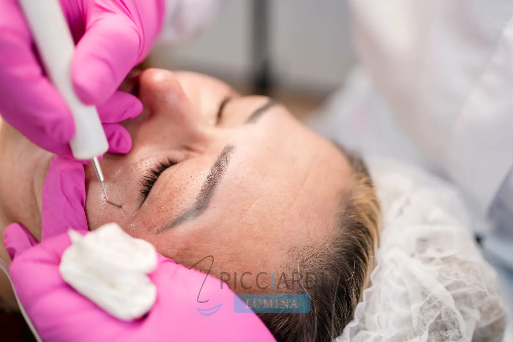 Blefaroplastica non chirurgica