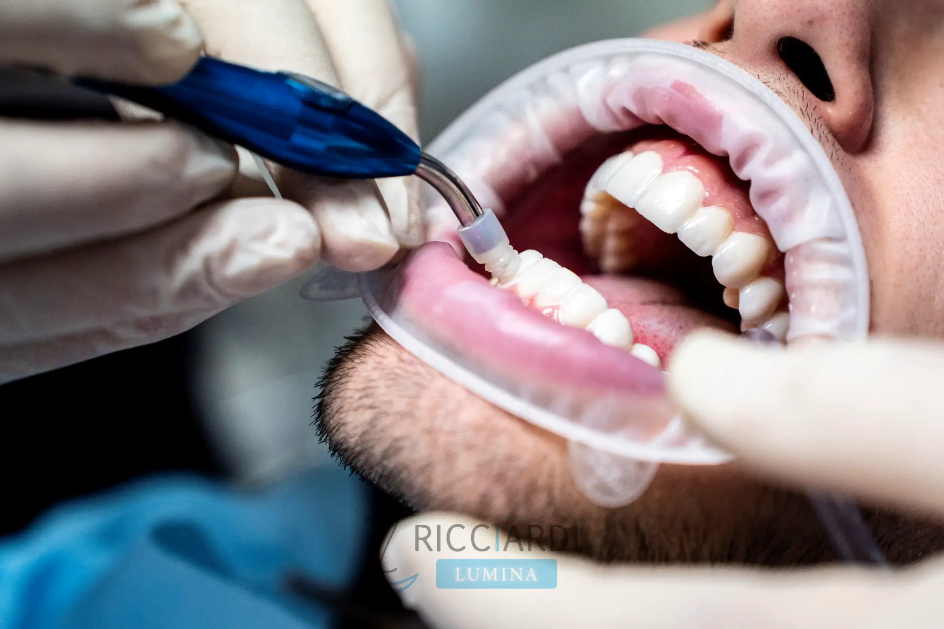 Un momento del trattamento: l’applicazione delle faccette dentali 🦷✨