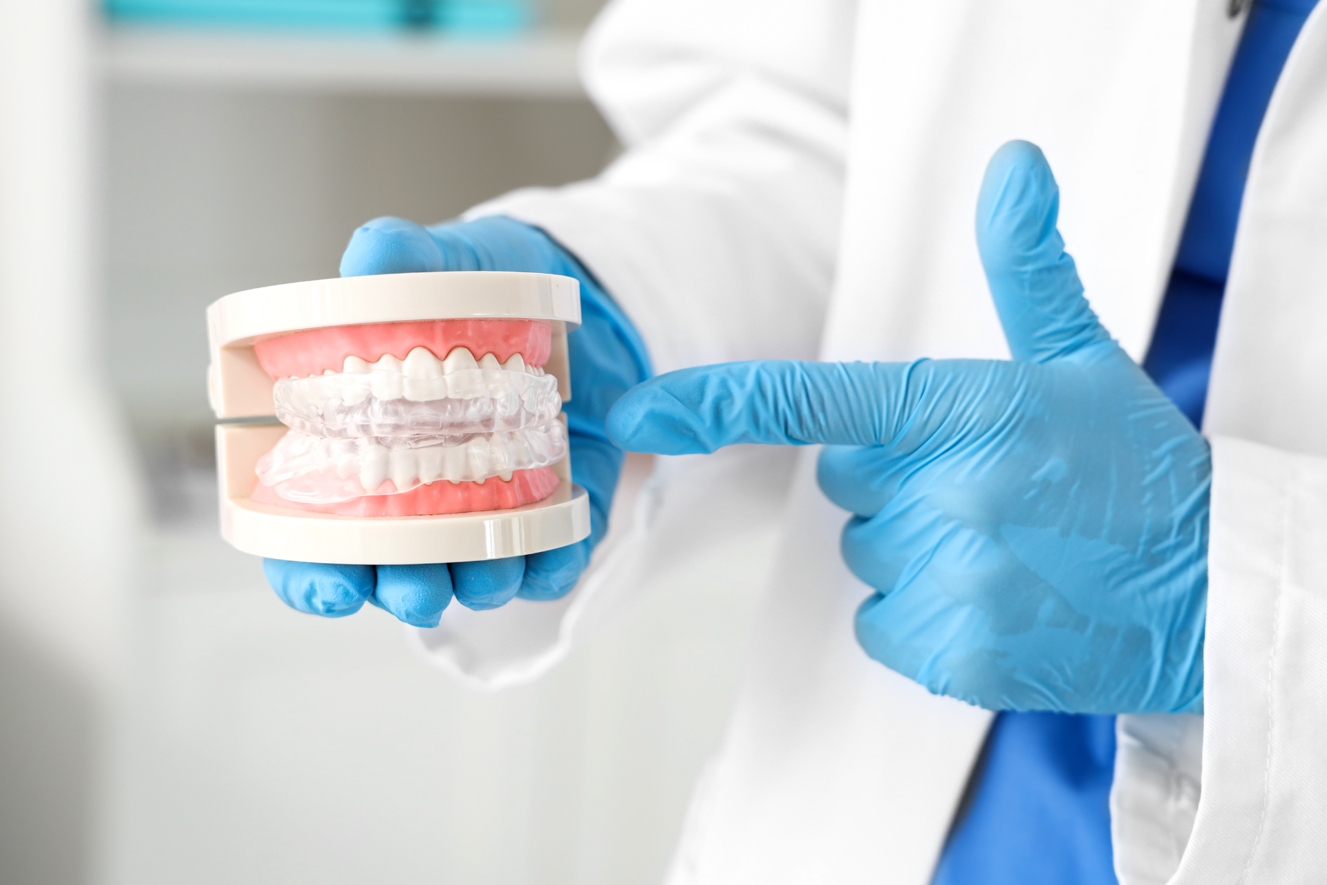 Bite trasparente per bruxismo mostrato su modellino dentale: una soluzione utile per proteggere i denti da serramento e digrignamento.