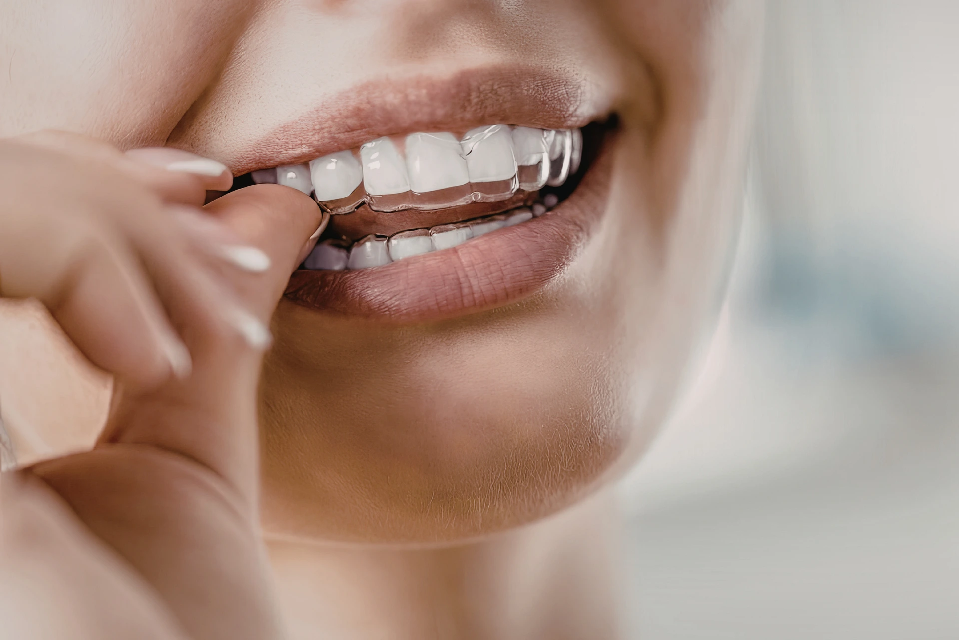 Scopri come funzionano gli allineatori trasparenti, come agiscono sui denti e perché sono una soluzione discreta per migliorare il sorriso.