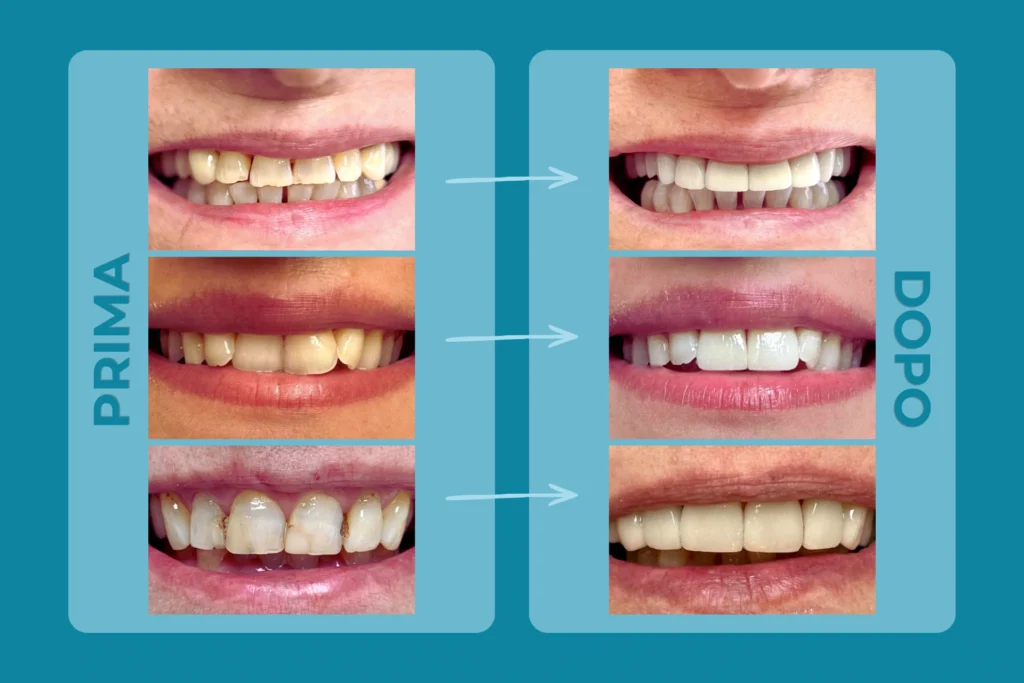 Confronto prima e dopo faccette dentali su più pazienti presso lo Studio Dentistico Ricciardi