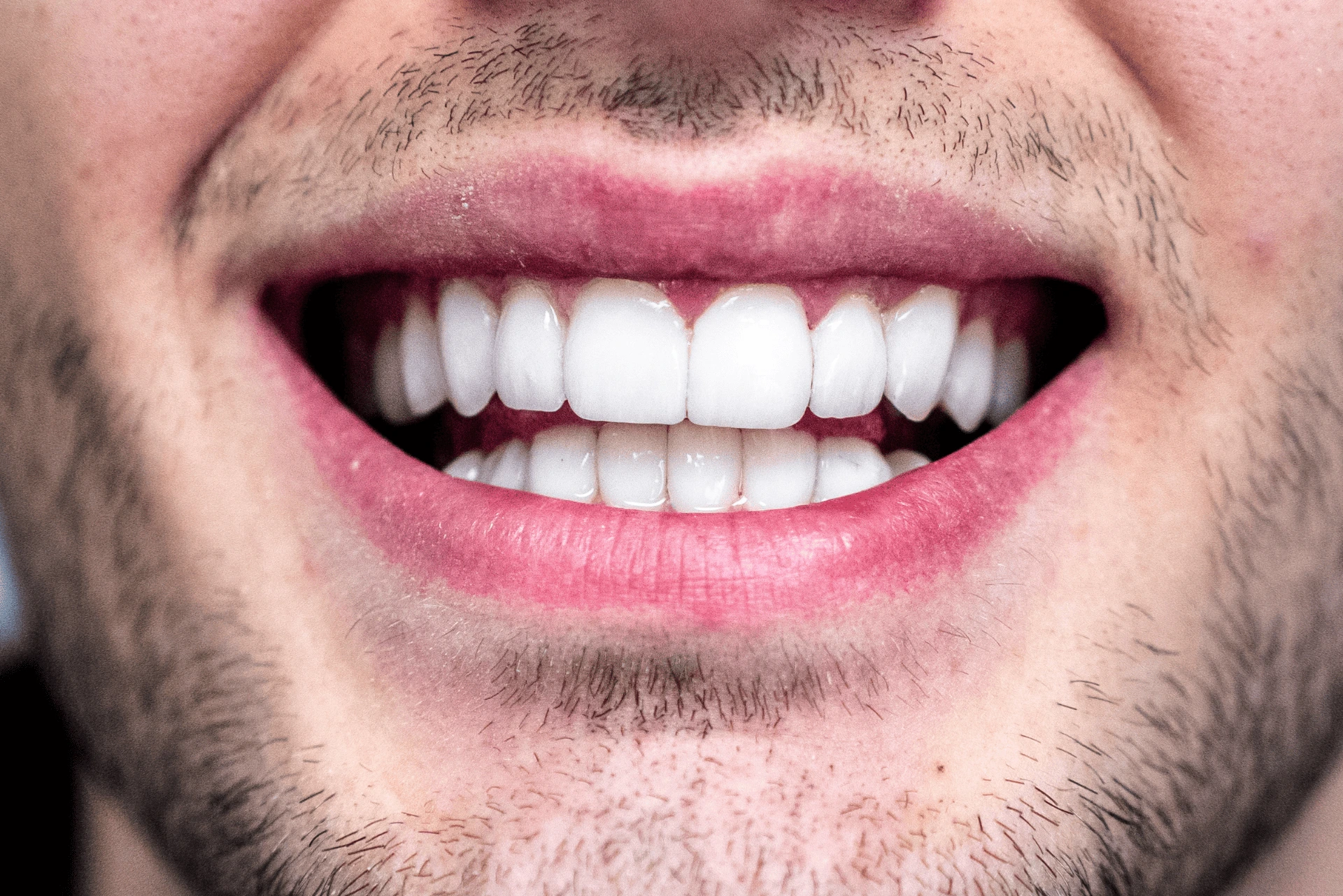 Questo è il sorriso di uno dei pazienti dello Studio Dentistico Ricciardi dopo aver applicato le faccette dentali, un trattamento estetico che permette di migliorare forma, colore e armonia dei denti.
Le faccette consentono di ottenere un risultato naturale e luminoso, rendendo il sorriso più uniforme e sicuro.