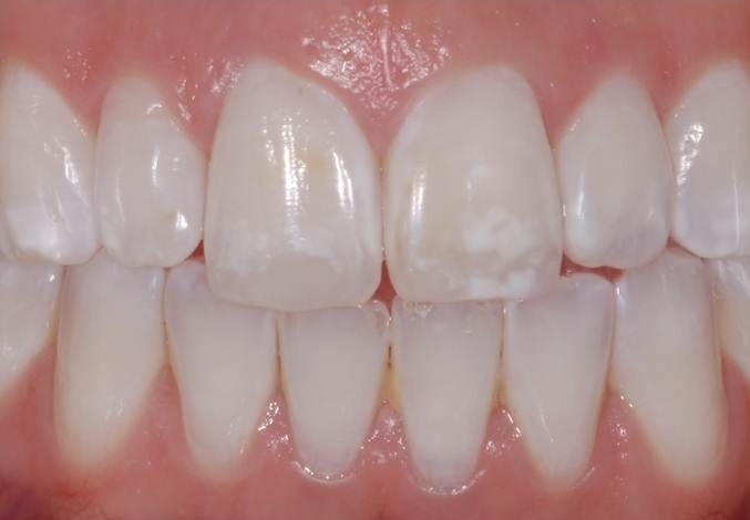 macchie bianche sui denti