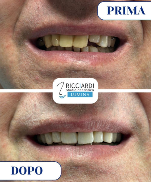 Giuseppe si è rivolto a noi con diversi problemi estetici e funzionali: denti disallineati, macchie evidenti e alcune scheggiature. Il suo obiettivo? Ritrovare un sorriso bello e sicuro. Oggi quel sorriso è realtà, grazie a un percorso personalizzato realizzato nel nostro studio. 😊 ✅ Trattamenti su misura ✅ Risultati naturali e duraturi Ogni sorriso racconta una storia. Se anche tu vuoi riscoprire la bellezza del tuo, vieni a trovarci per una consulenza gratuita.